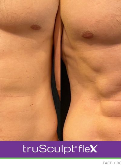 02_truSculpt flex_B&A_Opulence 02_truSculpt flex_B&A_Opulence
